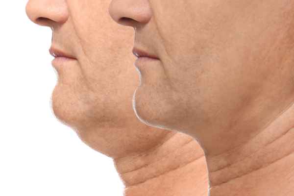 HIFU - Breakthrough in Anti - ageing 2 hifu results Kenilworth