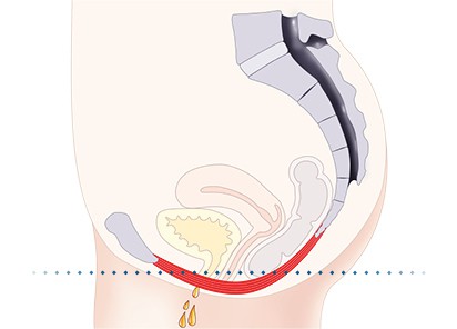 Pelvic-Floor Muscle Repair 5 Pelvic floor muscles Kenilworth