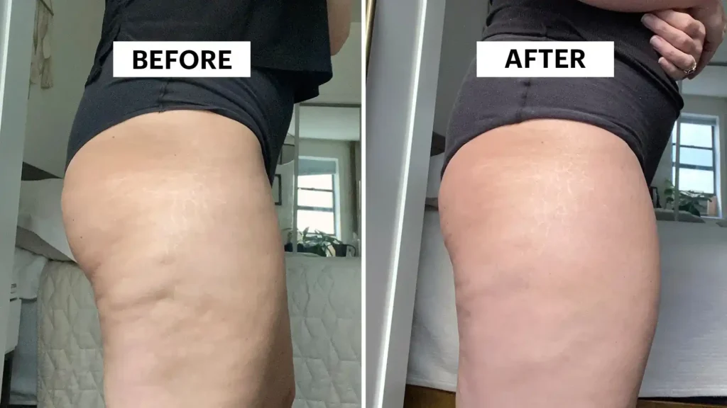 Sculpting Your Bum: Can Toning Exercises Really Reduce Cellulite? 1 Do Toning Exercise Kenilworth Really Tackle Cellulite?