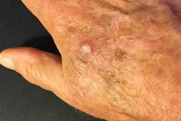 Image of Actinic keratoses Kenilworth on a person hand